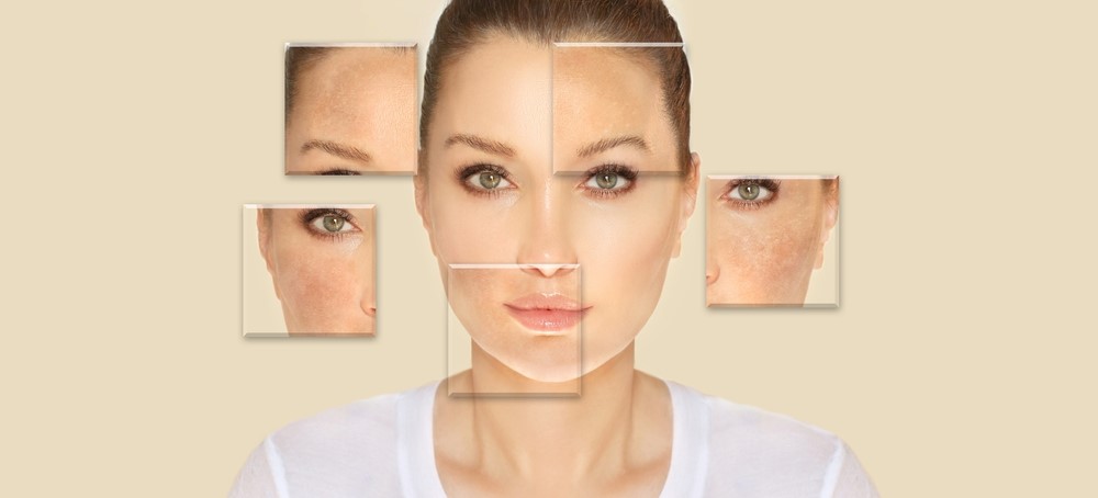 Expert Pigmentation Removal Services for a Brighter Complexion