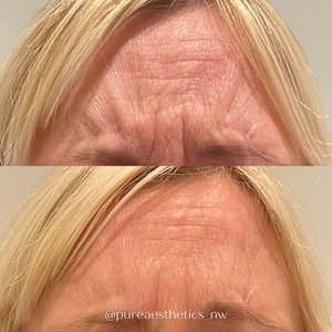 Dysport for deep forehead wrinkles
