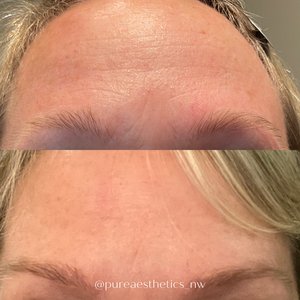 Dysport for deep forehead wrinkles