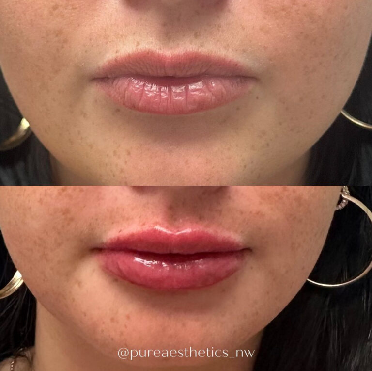 best lip plumper services in bellevue