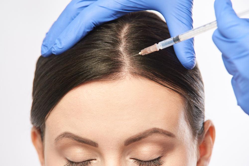 The Benefits of Platelet-Rich Fibrin (PRF) Hair Treatment in Hair Restoration