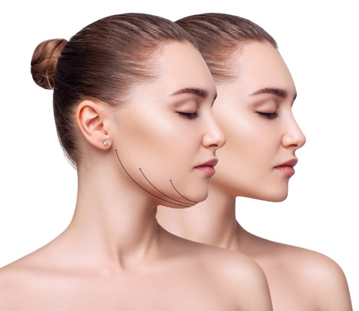 Transform Your Profile with Morpheus8: A Solution for Double Chin Reduction