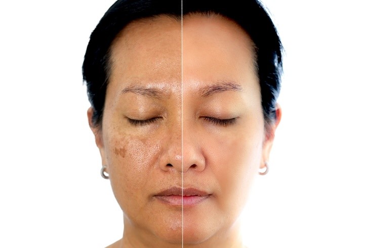 Why You Should Choose Minimally Invasive Treatment for Dark Spots on Your Face