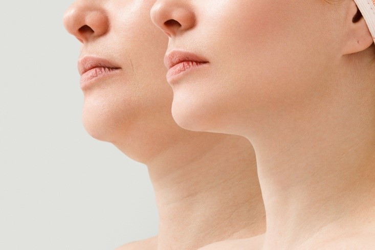 Why Finding a Qualified Kybella Provider in Bellevue is Important