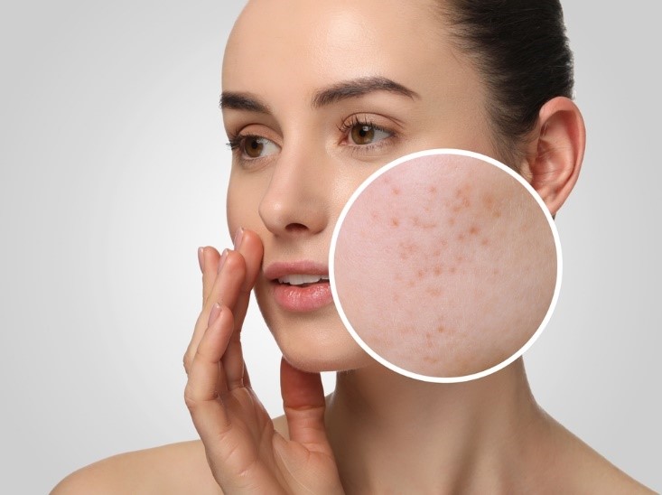 Why Non-Invasive Treatment is Ideal for Acne Scars: Beautiful Skin Without the Downtime